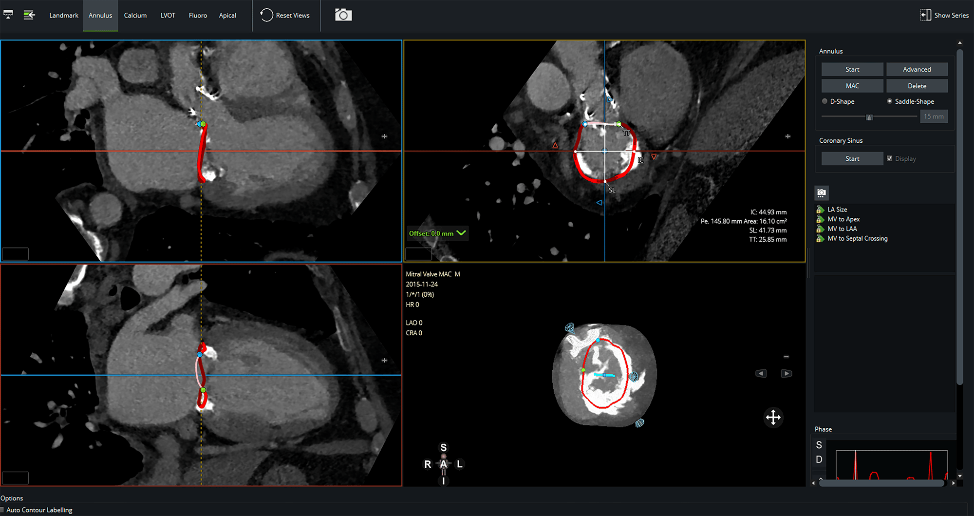 Mitral 6.3-1