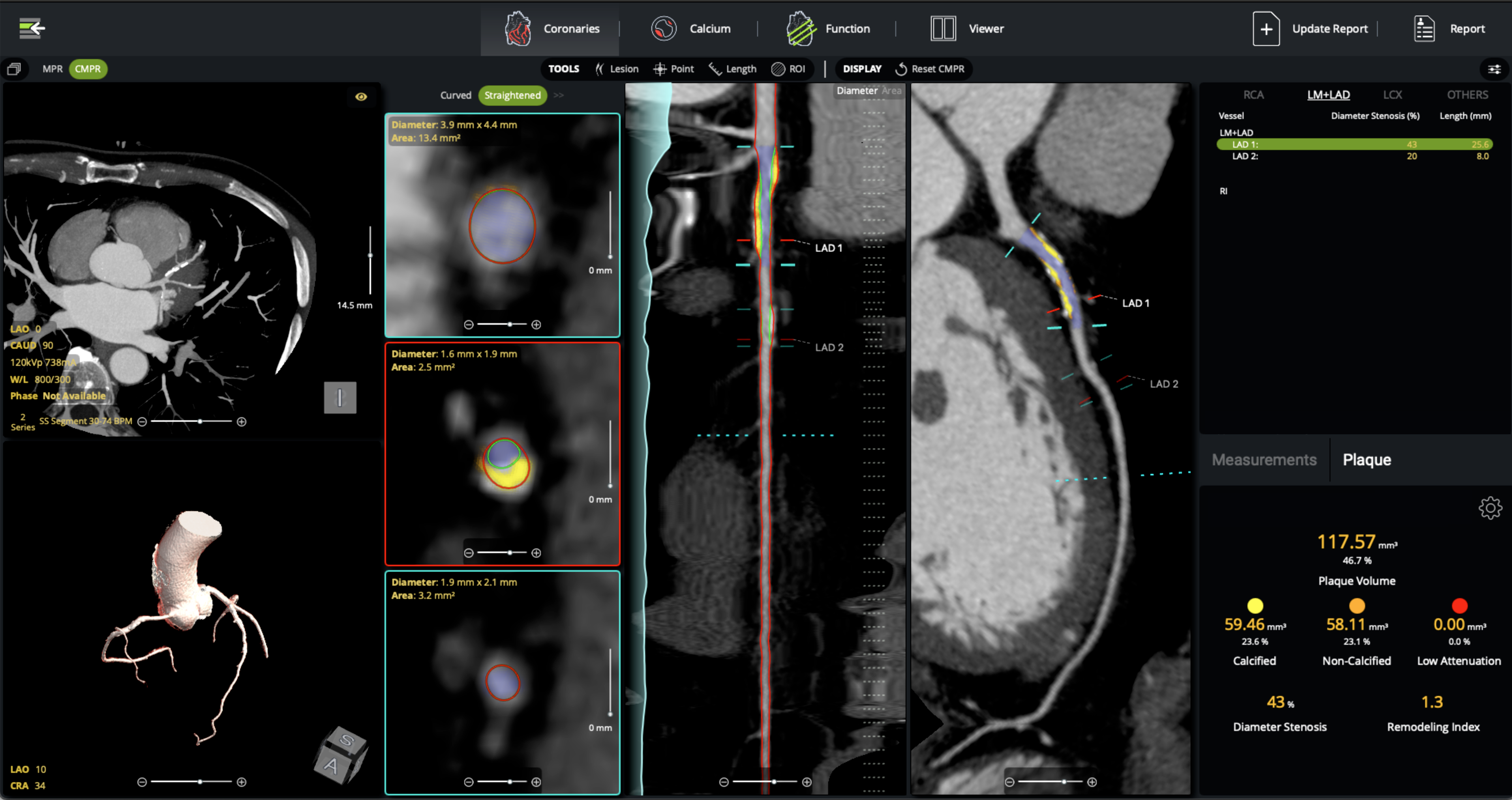 Coronary Plaque screenshot-2